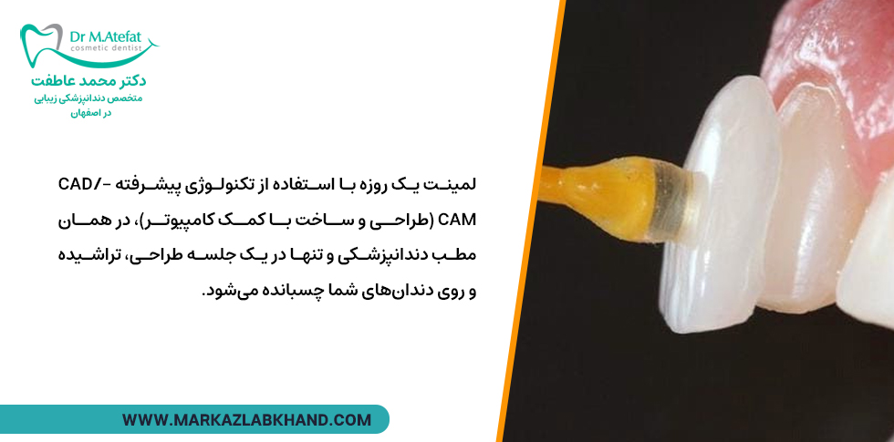 لمینت دندان یک روزه چیست؟