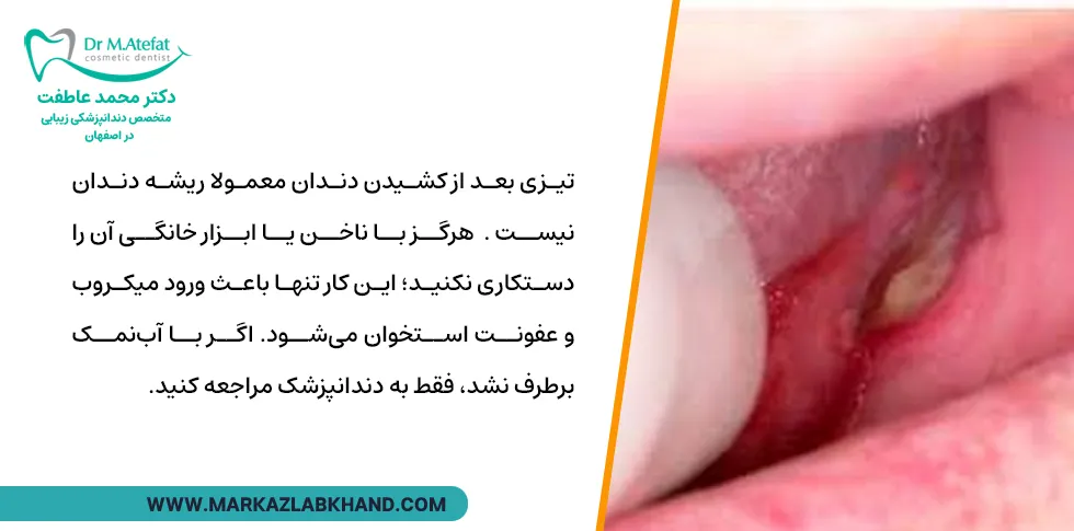 بیرون زدگی استخوان فک بعد از کشیدن دندان 