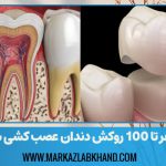 صفر تا 100 روکش دندان عصب کشی شده