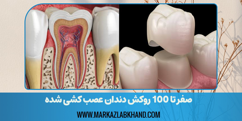 صفر تا 100 روکش دندان عصب کشی شده