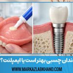 دندان چسبی بهتر است یا ایمپلنت؟
