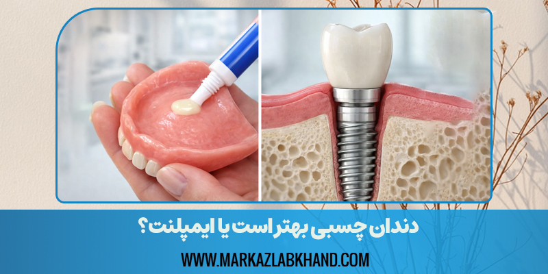 دندان چسبی بهتر است یا ایمپلنت؟