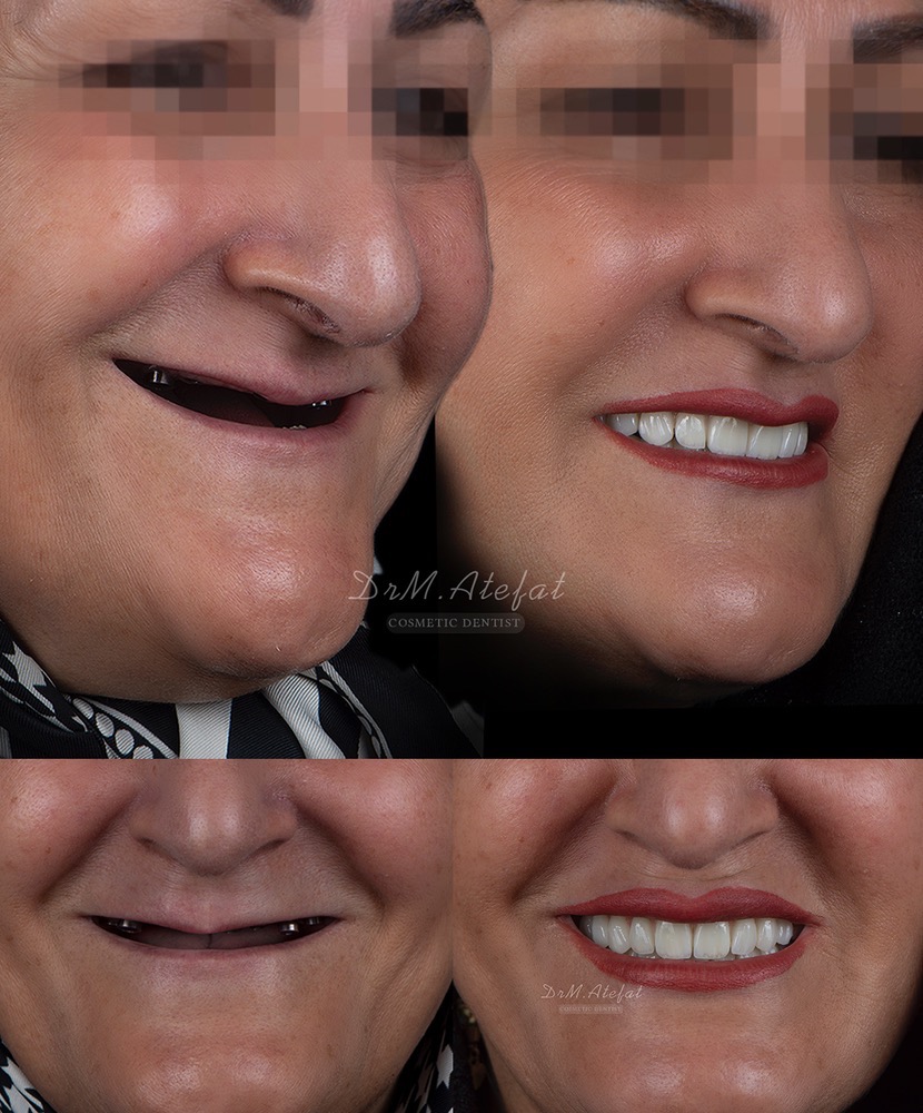طراحی لبخند با ترکیبی از ایمپلنت،روکش و لمینیت سرامیکی مراجعه کننده عزیز از یزد