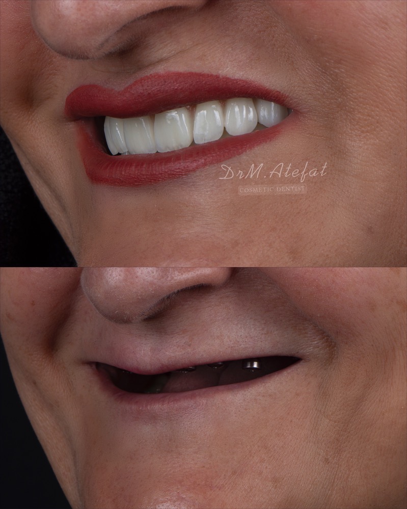 طراحی لبخند با ترکیبی از ایمپلنت،روکش و لمینیت سرامیکی مراجعه کننده عزیز از یزد