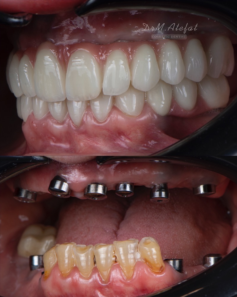 طراحی لبخند با ترکیبی از ایمپلنت،روکش و لمینیت سرامیکی مراجعه کننده عزیز از یزد