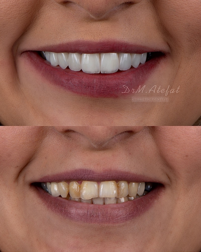 طراحی لبخند با ترکیبی از روکش و لمینیت سرامیکی مراجعه کننده عزیز از شاهین شهر