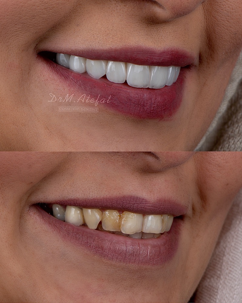طراحی لبخند با ترکیبی از روکش و لمینیت سرامیکی مراجعه کننده عزیز از شاهین شهر