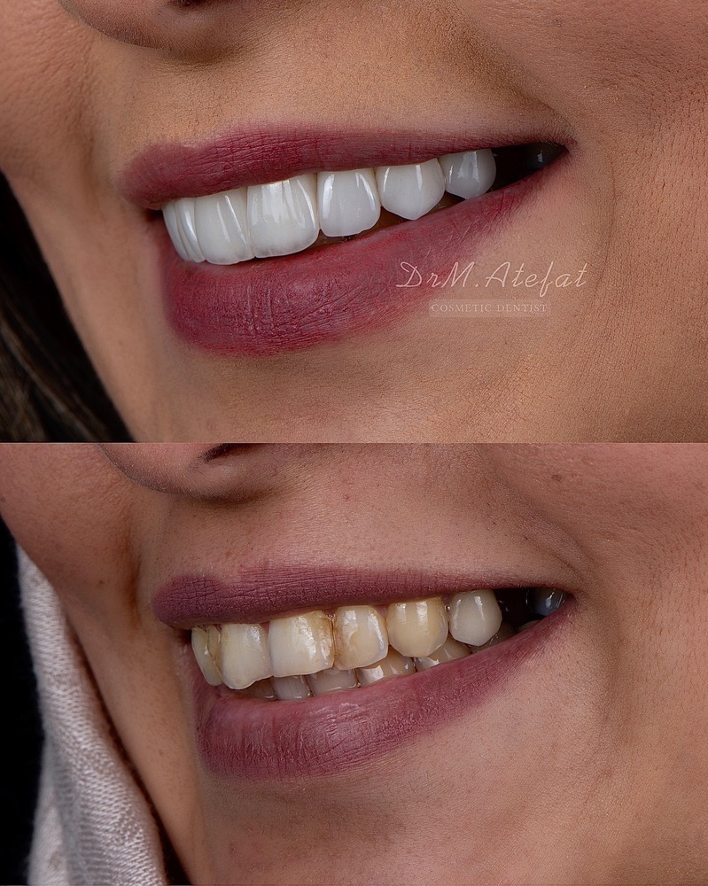طراحی لبخند با ترکیبی از روکش و لمینیت سرامیکی مراجعه کننده عزیز از شاهین شهر
