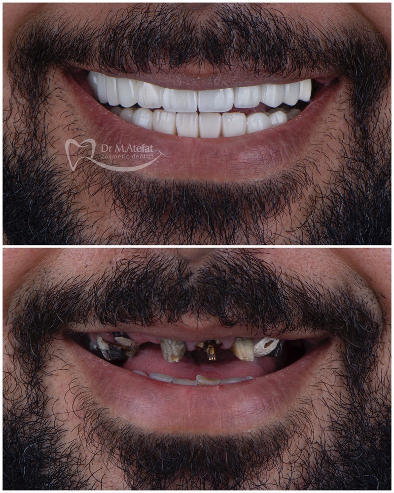 طراحی لبخند با انجام درمانهای ترکیبی جراحی لثه، ایمپلنت، روکش و لمینیت سرامیکی مراجعه کننده عزیز از اصفهان
