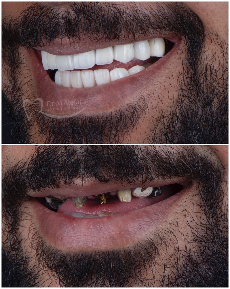 طراحی لبخند با انجام درمانهای ترکیبی جراحی لثه، ایمپلنت، روکش و لمینیت سرامیکی مراجعه کننده عزیز از اصفهان