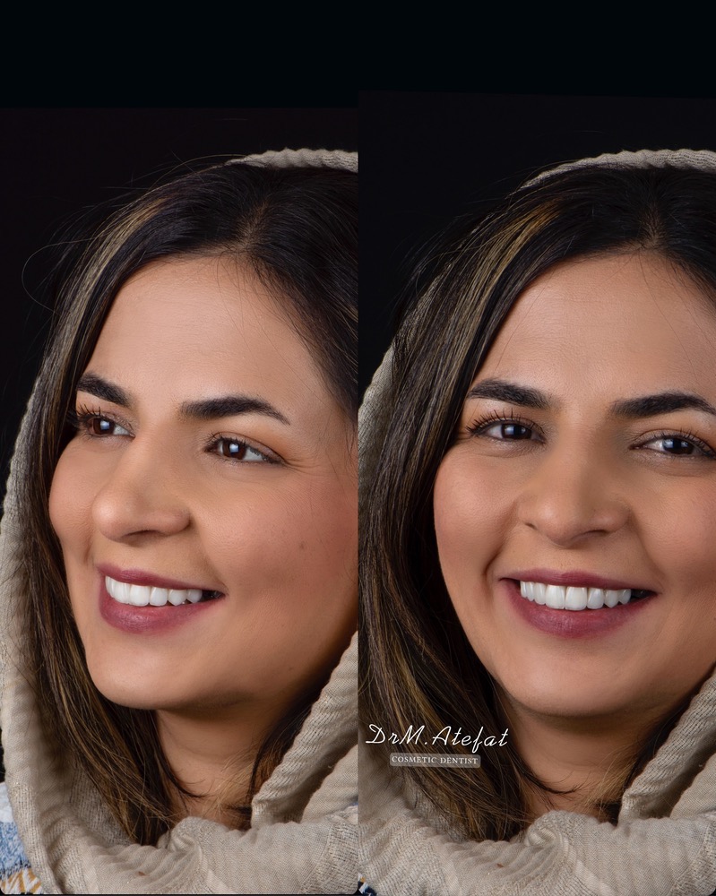 طراحی لبخند با ترکیبی از روکش و لمینیت سرامیکی مراجعه کننده عزیز از شاهین شهر