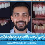 طراحی لبخند با انجام درمانهای ترکیبی جراحی لثه، ایمپلنت، روکش و لمینیت سرامیکی مراجعه کننده عزیز از اصفهان