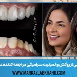 طراحی لبخند با ترکیبی از روکش و لمینیت سرامیکی مراجعه کننده عزیز از شاهین شهر