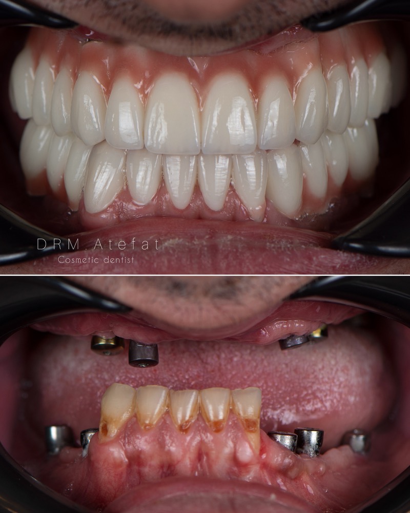 طراحی لبخند با ترکیبی از ایمپلنت و لمینیت سرامیکی مراجعه کننده عزیز از شهرضا