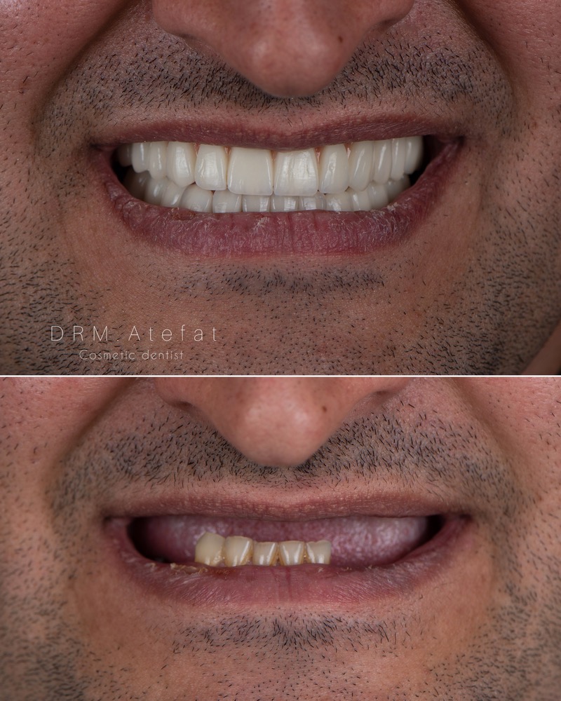 طراحی لبخند با ترکیبی از ایمپلنت و لمینیت سرامیکی مراجعه کننده عزیز از شهرضا