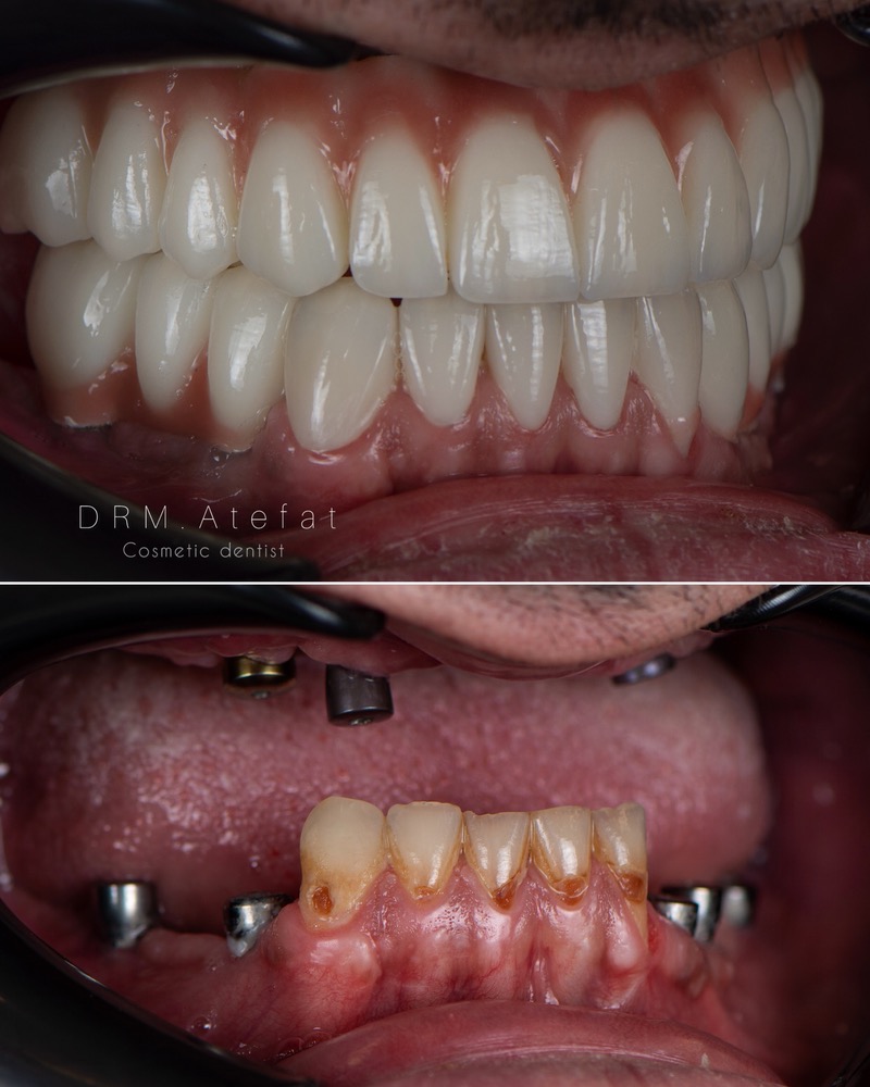 طراحی لبخند با ترکیبی از ایمپلنت و لمینیت سرامیکی مراجعه کننده عزیز از شهرضا