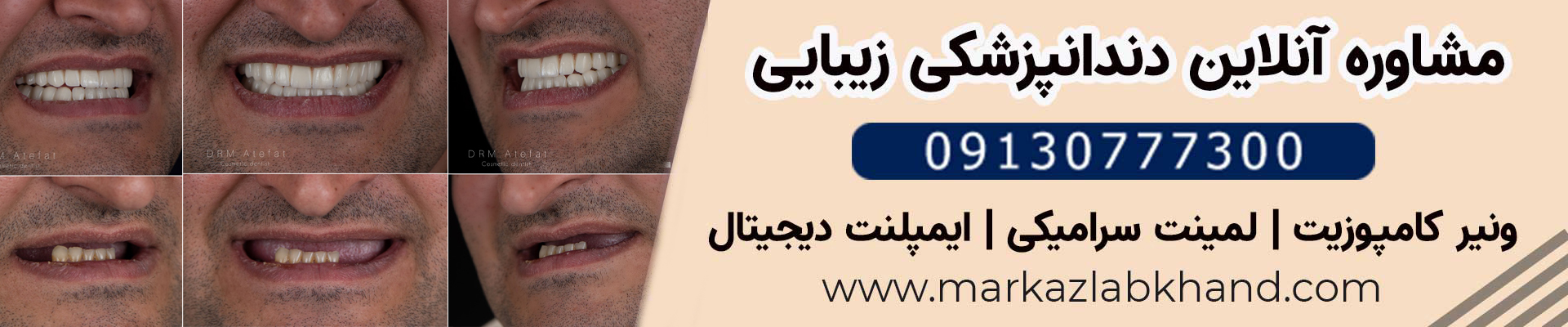 طراحی لبخند با ترکیبی از ایمپلنت و لمینیت سرامیکی مراجعه کننده عزیز از شهرضا