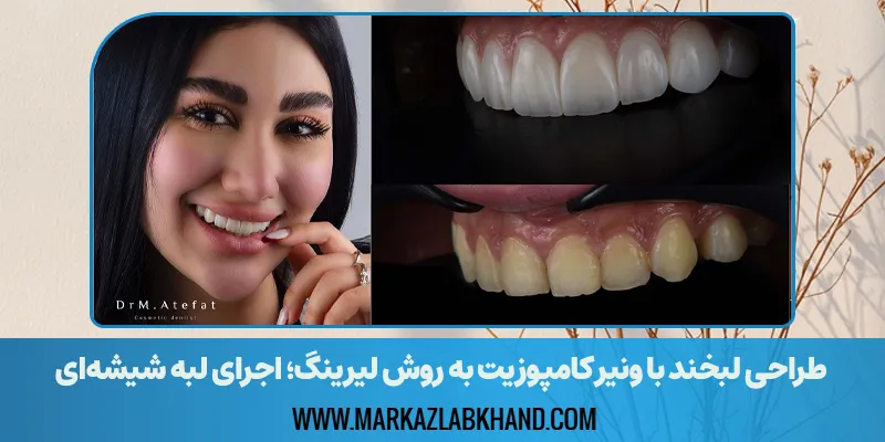 طراحی لبخند با ونیر کامپوزیت به روش لیرینگ؛ اجرای لبه شیشه‌ای