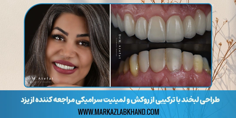 نتیجه درمانی لیمنت سرامیکی مراجعه کننده از یزد در مطب دکتر محمد عاطفت