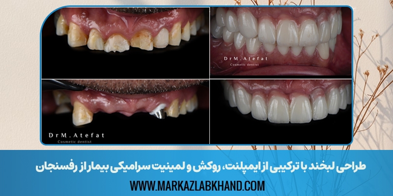 طراحی لبخند با ترکیبی از ایمپلنت، روکش و لمینیت سرامیکی بیمار از رفسنجان