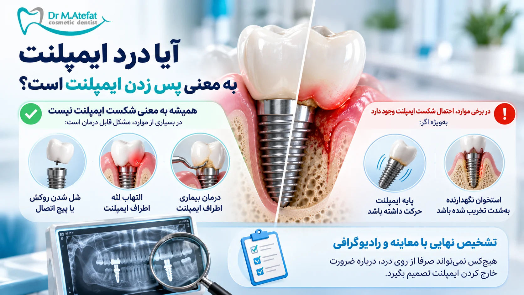 آیا درد ایمپلنت به معنی پس زدن ایمپلنت است؟