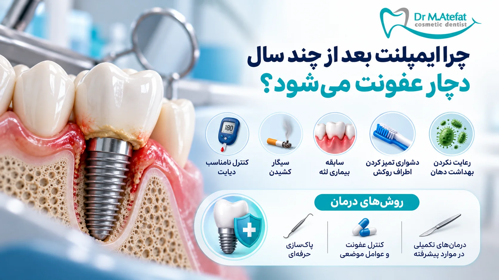 چرا ایمپلنتی که چند سال سالم بوده، دچار عفونت میشود؟