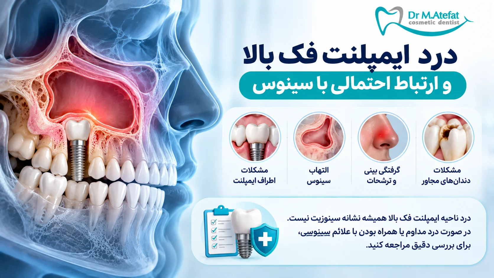 درد ایمپلنت فک بالا و ارتباط احتمالی با سینوس