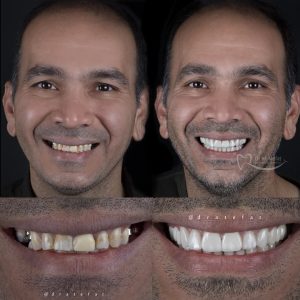 ترکیب روکش و لمینت سرامیکی در اصفهان