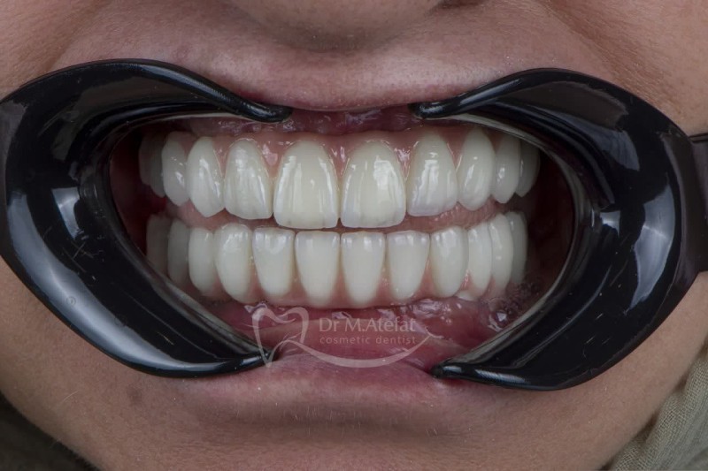 ایمپلنت کامل دو فک در اصفهان