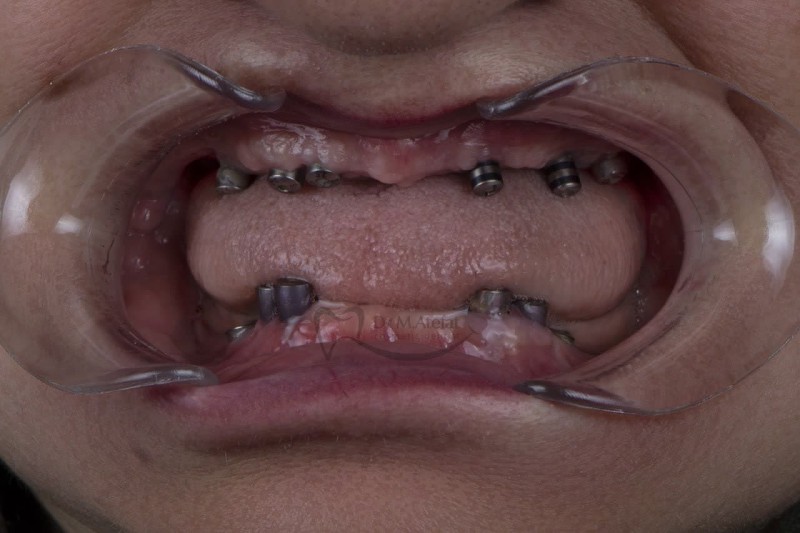 ایمپلنت کامل دو فک در اصفهان