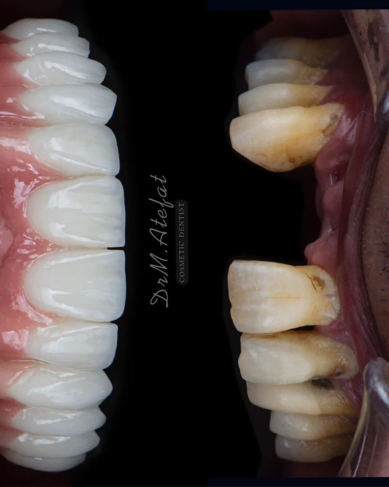 کاشت ایمپلنت در اصفهان