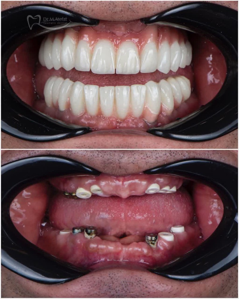 کاشت ایمپلنت در اصفهان