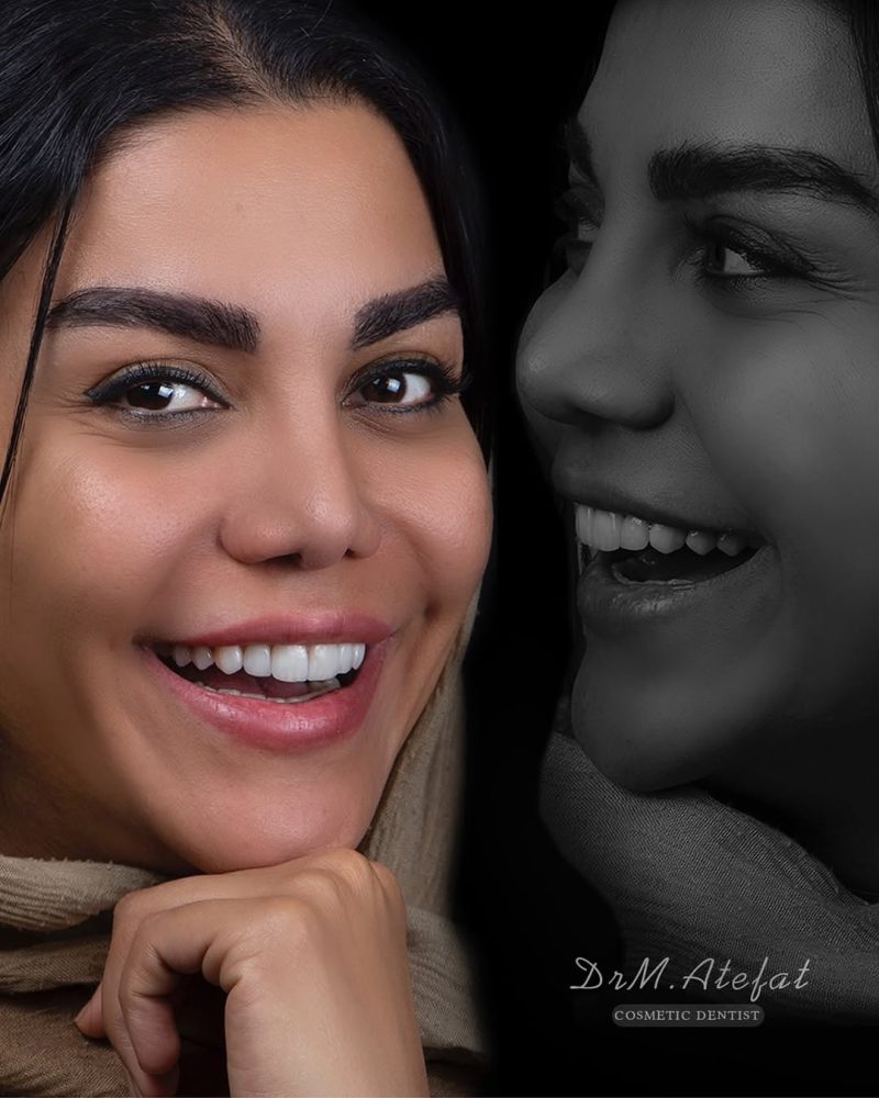 نمونه درمان لمینیت سرامیکی در اصفهان