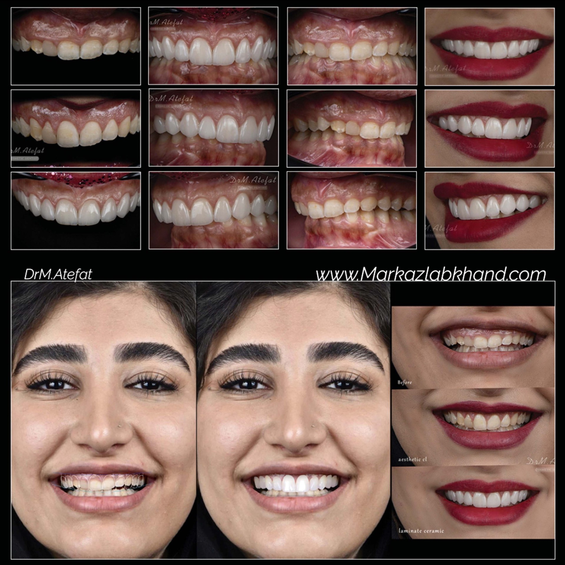 لمینیت سرامیکی دیجیتال در اصفهان توسط دکتر محمد عاطفت