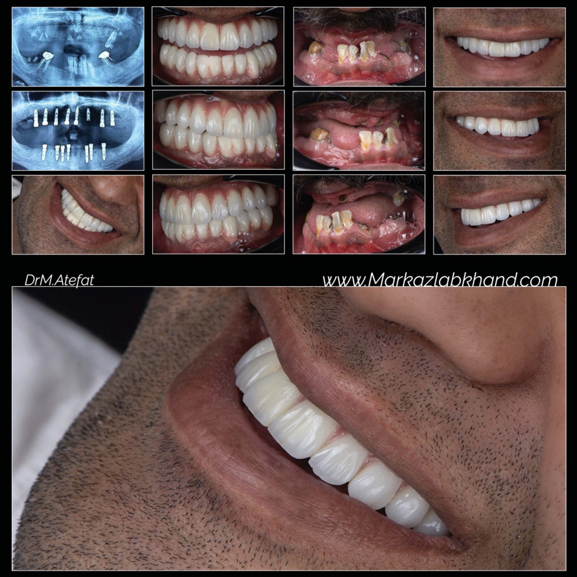 کاشت ایمپلنت دیجیتال در اصفهان فک بالا و پایین