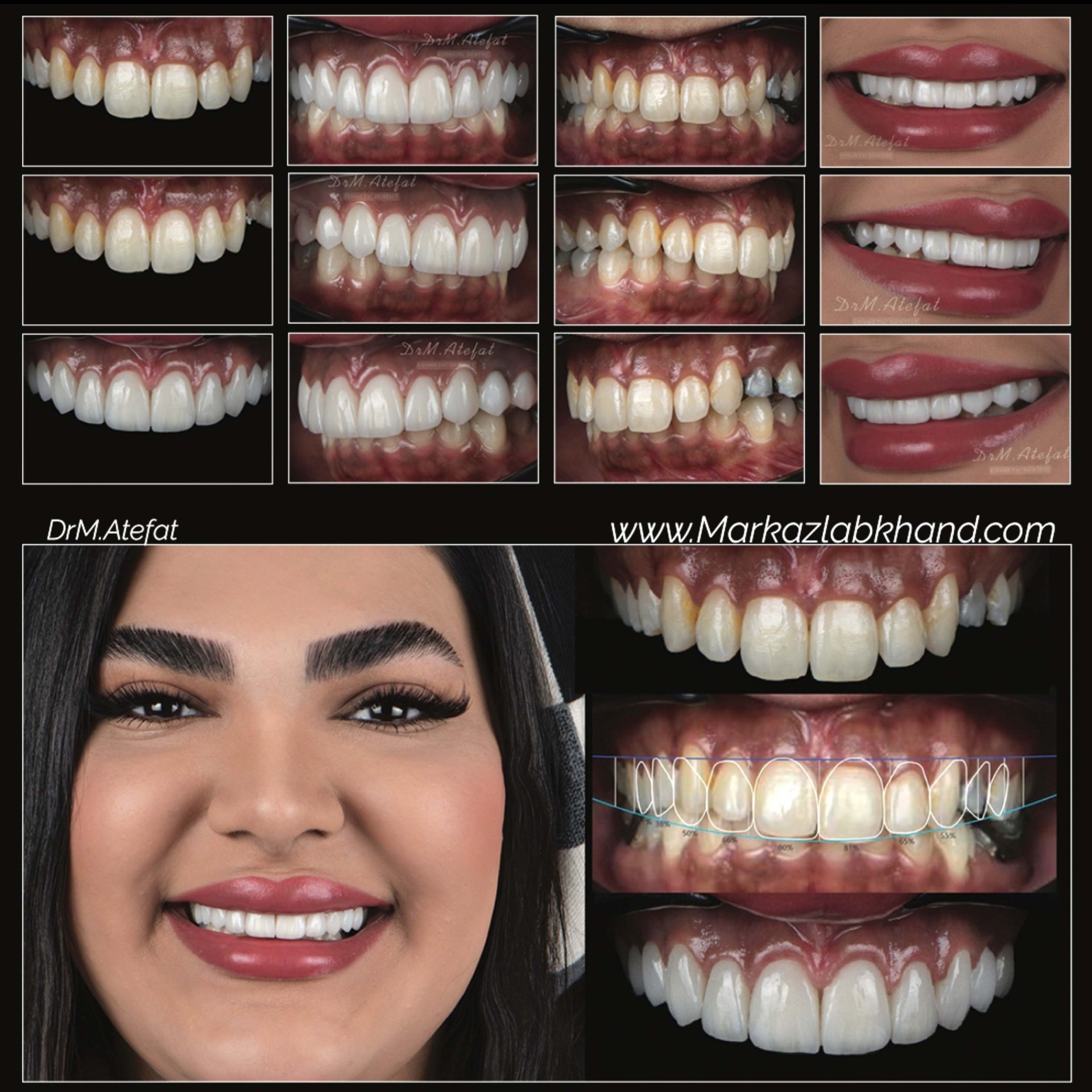 لمینیت سرامیکی دیجیتال در اصفهان توسط دکتر محمد عاطفت