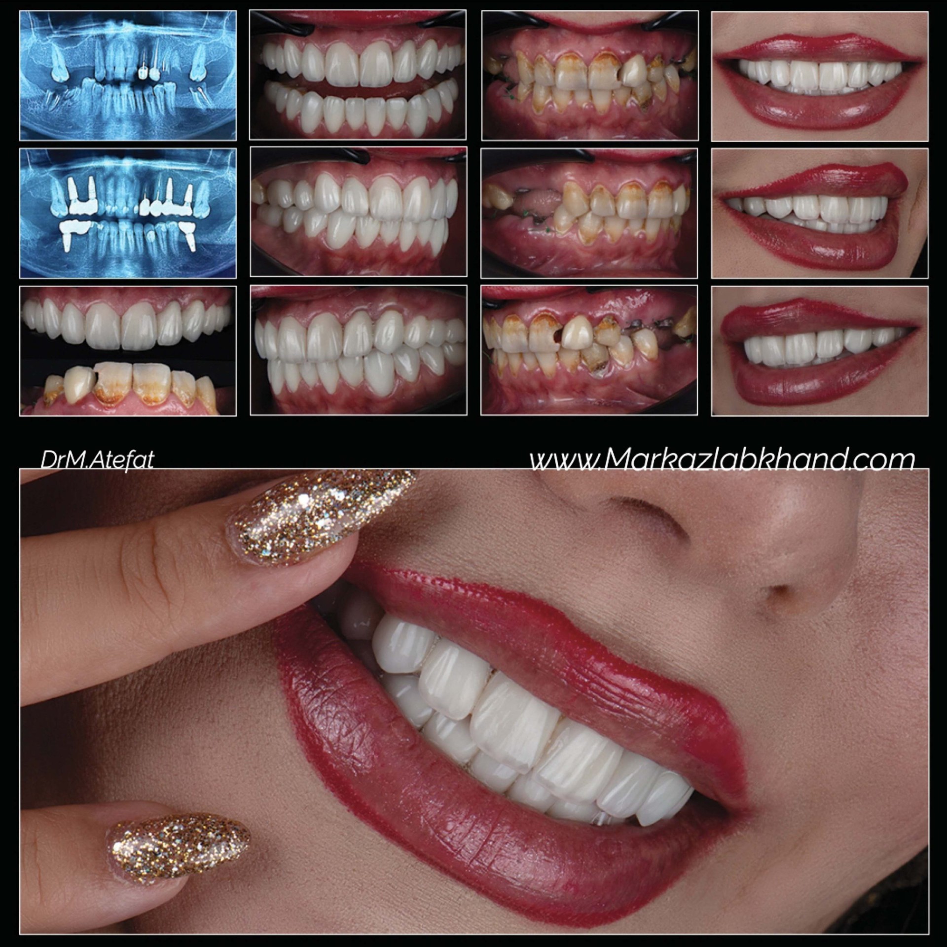 کاشت ایمپلنت دیجیتال در اصفهان فک بالا و پایین